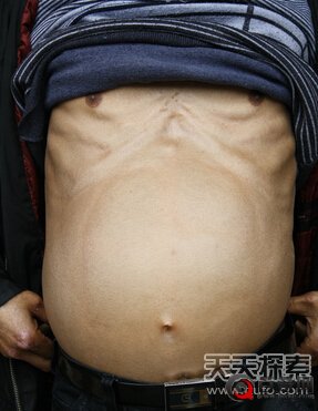 重庆一男子竟“怀孕”30年产下一怪胎