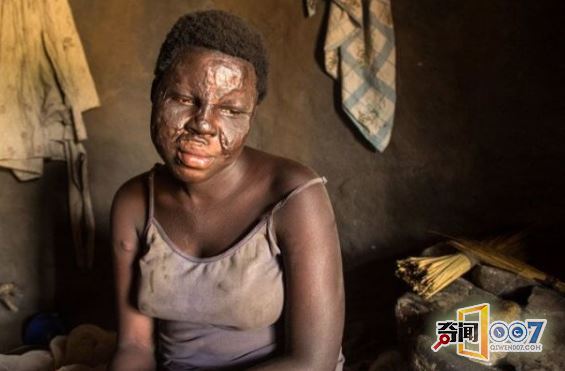 上万儿童患罕见点头病，十几岁就面临死亡