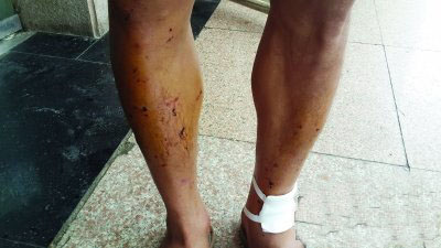 贵阳男子身体两声闷响“炸”出百道伤口 自我爆炸