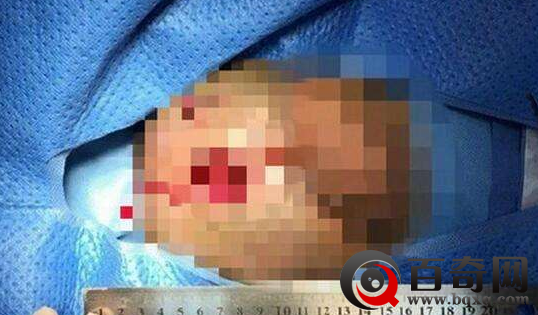 少年打麻药自宫 自称想做女人