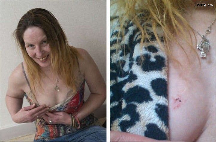 英女子意外与加州王蛇同眠胸部被咬