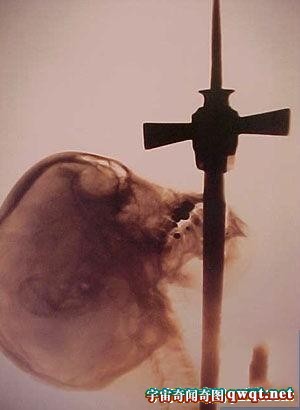 吞剑艺术并非欺骗 X光图片可证明