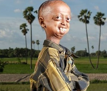 印度14岁少年阿里侯赛因患罕见早衰症全世界仅80人