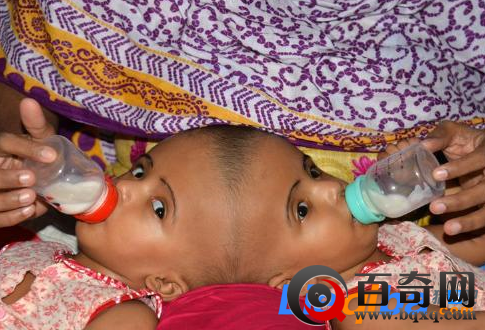 头部连体女婴将接受分离手术 存活率非常低