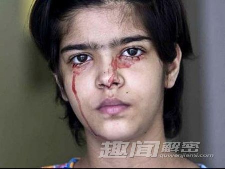 印度女子得怪病泪血症 发病时七窍流血