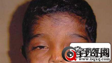 历数全世界最神奇恐怖的十大怪病！