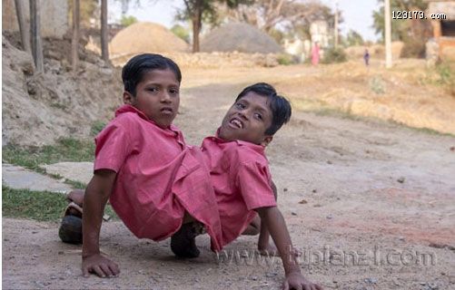 印度连体兄弟被奉为神灵