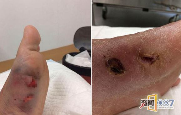 女子泰国度假遭黄貂鱼攻击 险象环生