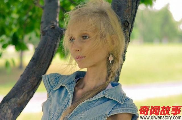 直击24岁俄罗斯女孩减肥变成“活骷髅”，体重只剩42斤