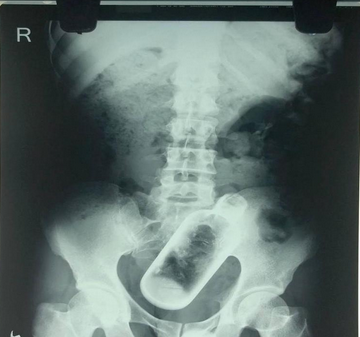 印度男子腹中有个酒瓶 竟是喝酒时吞下去的_0