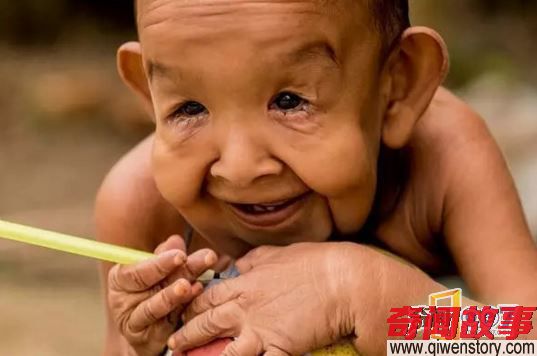 4岁男孩像80岁老翁