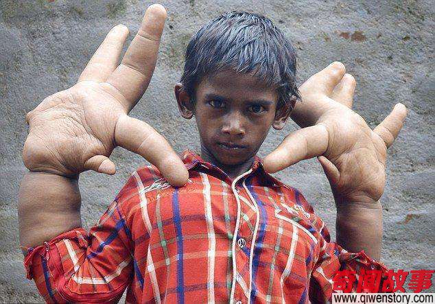 印度8岁男童患巨指症，手掌长33cm，村民认为他是魔鬼男孩