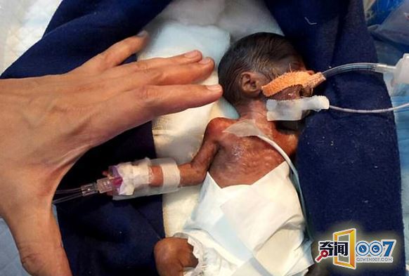 印早产男婴仅手掌大 成功接受心脏手术