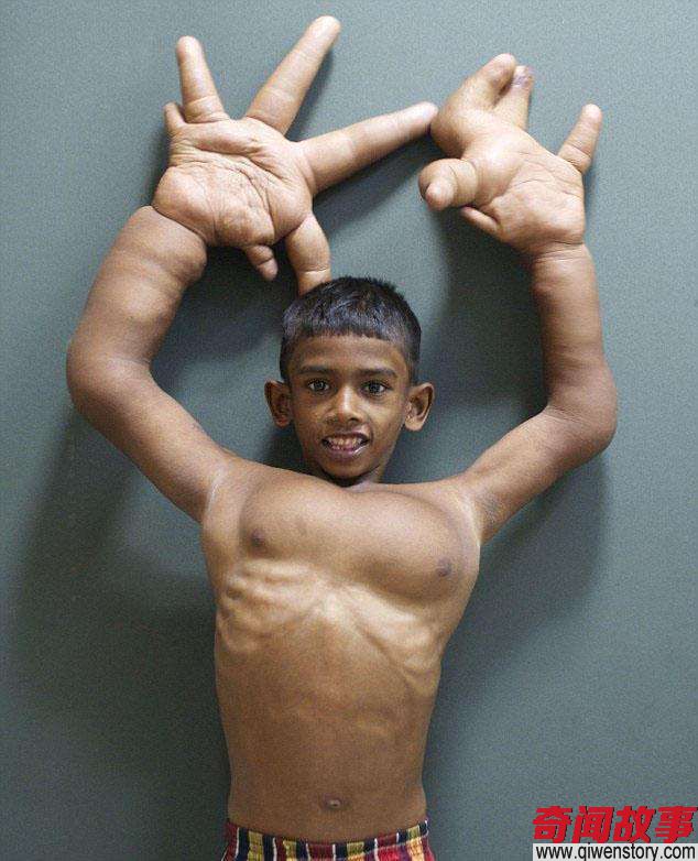 印度8岁男童患巨指症，手掌长33cm，村民认为他是魔鬼男孩
