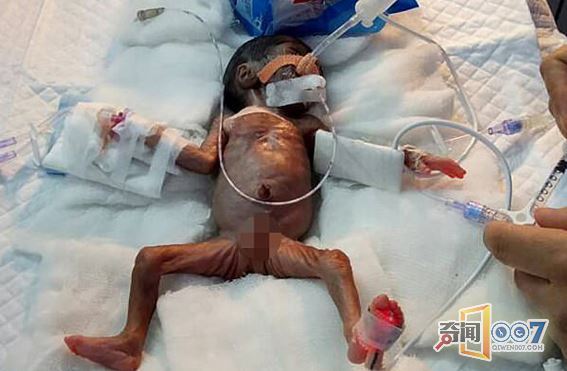 印早产男婴仅手掌大 成功接受心脏手术