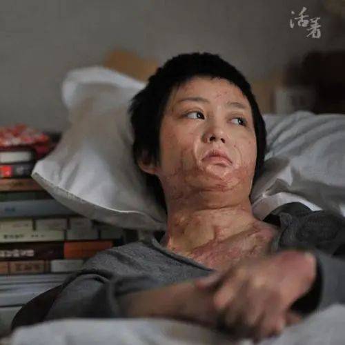9年前，那位拒绝官二代表白，被汽油烧毁容的16岁女孩，现怎样了