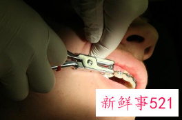 拔智齿疼几天属于正常