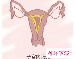 子宫内膜炎的注意事项