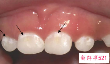 婴儿牙齿脱矿怎么办