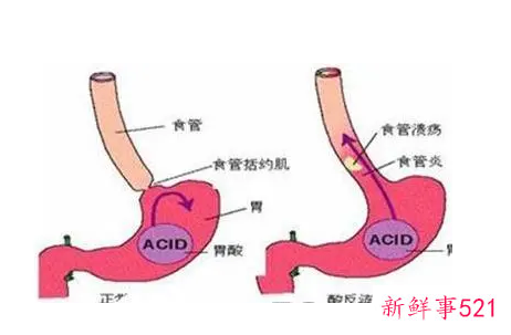 食道癌的形成需要几年