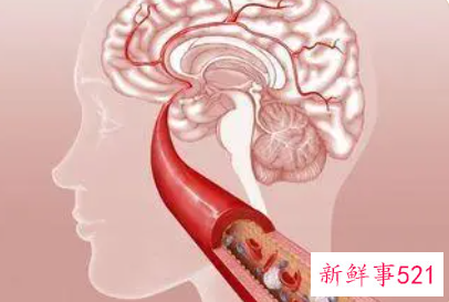 脑动脉硬化怎么治疗