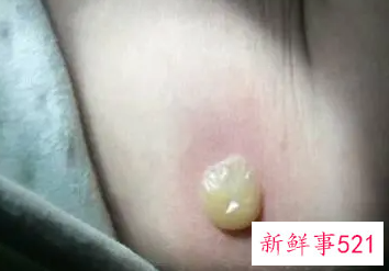 为什么卡介苗化脓后出现个洞