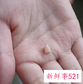 换牙乳牙断了牙根还在里面