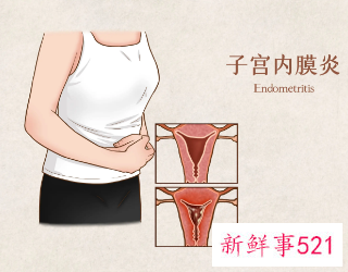 子宫内膜炎的注意事项