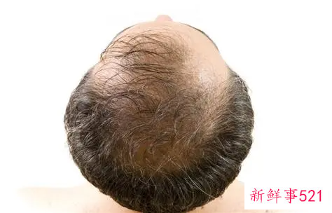 治疗秃头最好的方法