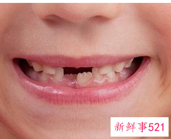 儿童换牙该注意什么