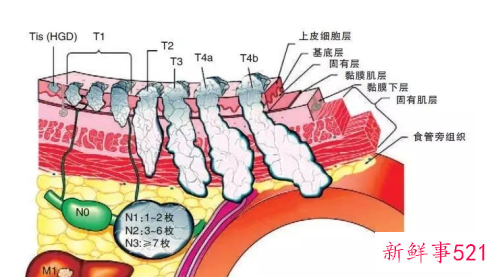 食道癌的形成需要几年