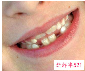 儿童换牙该注意什么