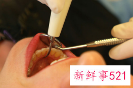 拔智齿疼几天属于正常