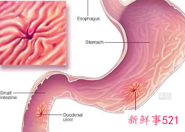 幽门螺旋杆菌被列为一级致癌物