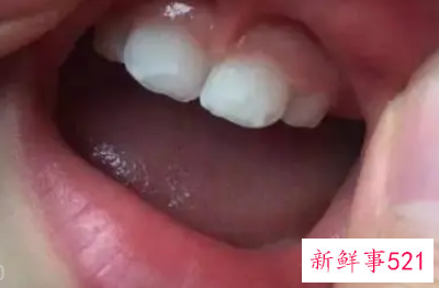 婴儿牙齿脱矿怎么办