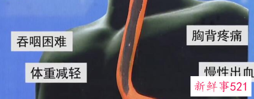 食道癌的形成需要几年