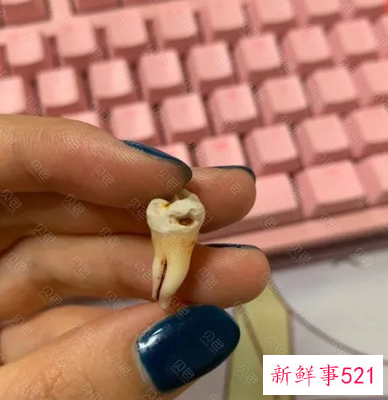 智齿很痛的时候可以拔吗