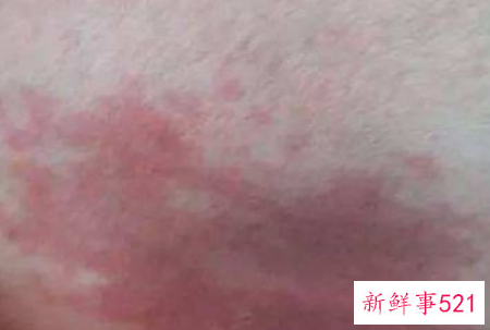 婴儿脸上有胎记怎么办