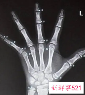 小孩测骨龄有什么影响