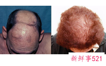 我国脱发人群逐渐年轻化,每6人就有1人脱发