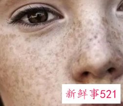 怎么减少黑色素