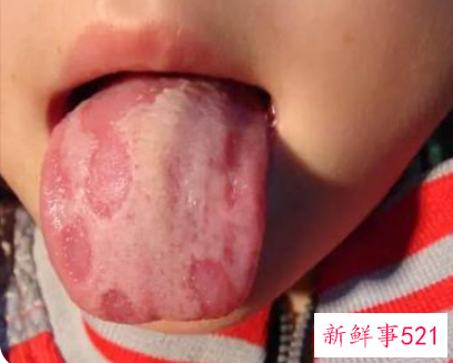 别忽视孩子的地图舌