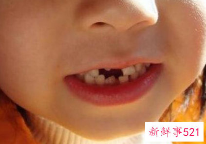 儿童退牙的顺序24颗牙