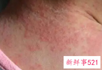 婴儿如何去痱子最有效