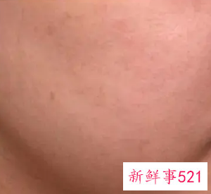 果酸对人体的危害