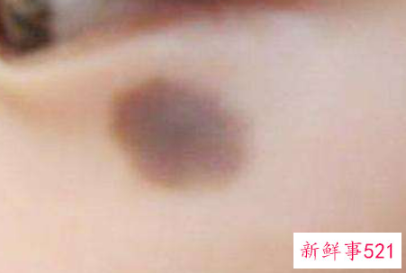 婴儿脸上有胎记怎么办