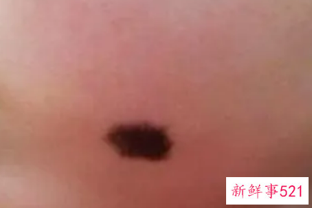 婴儿脸上有胎记怎么办