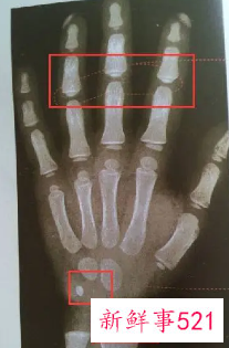 小孩测骨龄有什么影响