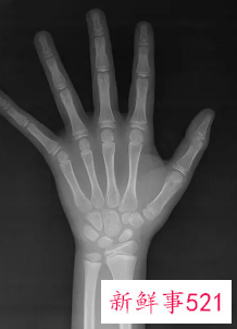 小孩测骨龄有什么影响