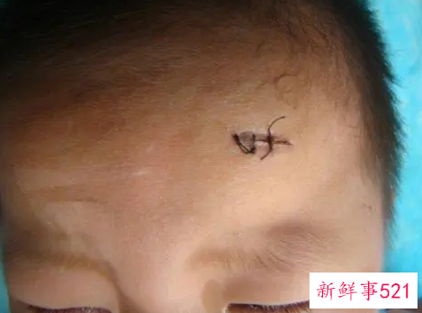 小孩额头缝了6针会不会留疤呀